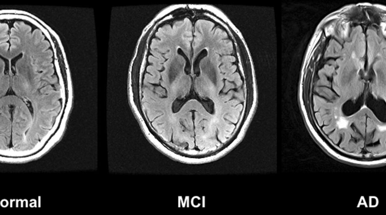 Demenz: Schreckgespenst oder gesellschaftliche Herausforderung?